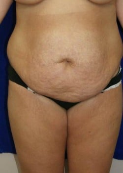 Before Image: Liposuction - front