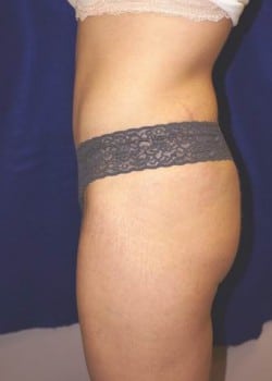 After Image: Liposuction - other
