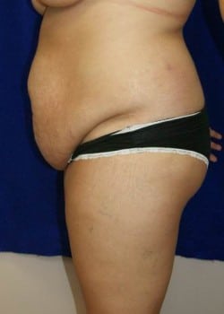 Before Image: Liposuction - other
