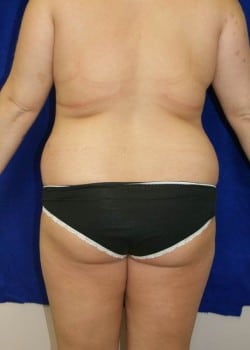 Before Image: Liposuction - back