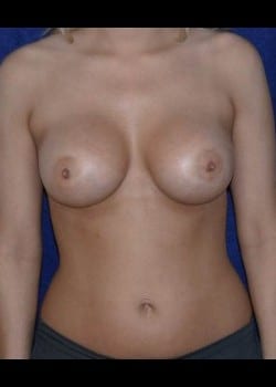 After Image: Breast Augmentation with Saline breast implants - front