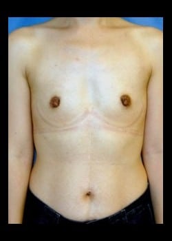 Before Image: Breast Augmentation with Silicone Breast Implants - front