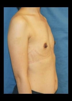 Before Image: Breast Augmentation with Silicone Breast Implants - front
