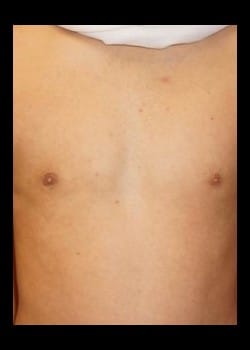 After Image: Unilateral gynecomastia - front