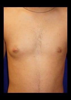 Before Image: Unilateral gynecomastia - front