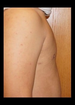 After Image: Unilateral gynecomastia - other