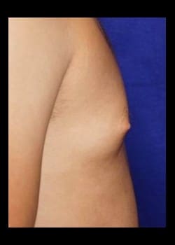 Before Image: Unilateral gynecomastia - other
