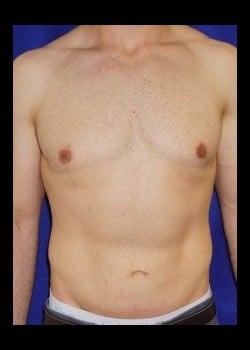 After Image: Bilateral gynecomastia - front