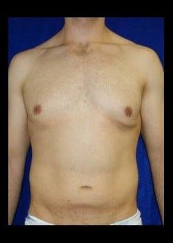 Before Image: Bilateral gynecomastia - front