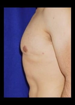 After Image: Bilateral gynecomastia - other
