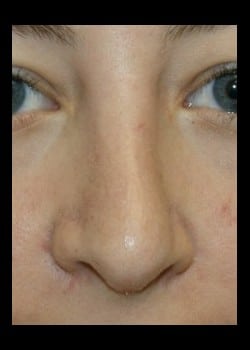 After Image: Rhinoplasty for twisted nasal deformity - front