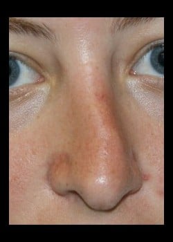 Before Image: Rhinoplasty for twisted nasal deformity - front