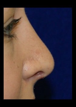 After Image: Rhinoplasty for twisted nasal deformity - other