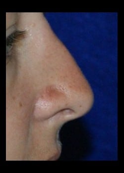Before Image: Rhinoplasty for twisted nasal deformity - other
