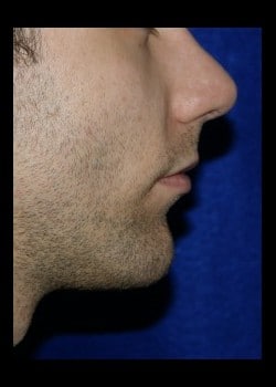 After Image: Chin Implant - front