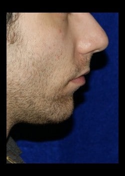 Before Image: Chin Implant - front