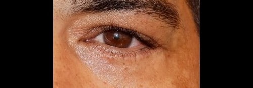 After Image: Lower lid blepharoplasty with fat transposition over the orbital rim - front