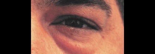 Before Image: Lower lid blepharoplasty with fat transposition over the orbital rim - front