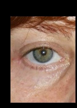 After Image: Upper and Lower Lid Blepharoplasty - front