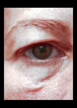 Before Image: Upper and Lower Lid Blepharoplasty - front