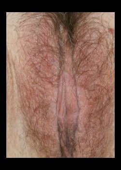 After Image: Labiaplasty Before and After - front
