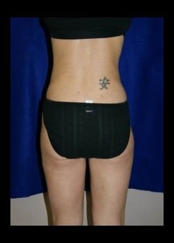 After Image: Liposuction of sides and thighs - front
