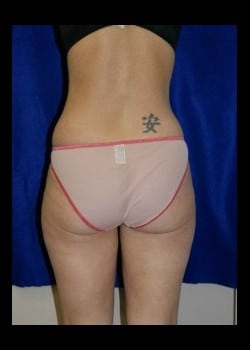 Before Image: Liposuction of sides and thighs - front