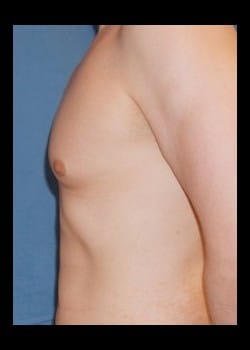 Before Image: Gynecomastia reduction - other