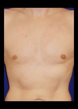 After Image: Gynecomastia reduction - front