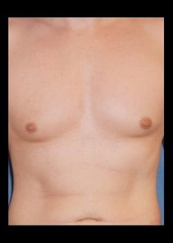 Before Image: Gynecomastia reduction - front