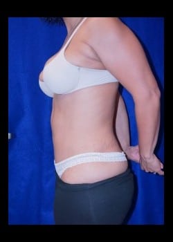 After Image: Tummy tuck and liposuction - other