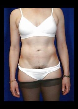 After Image: Liposuction of the abdomen, flanks and sides - front