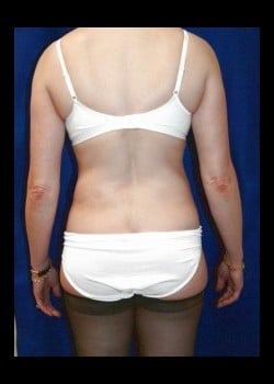 After Image: Liposuction of the abdomen, flanks and sides - back