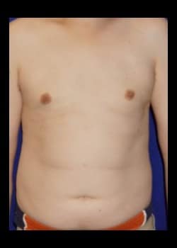 After Image: Severe Gynecomastia before and after - front