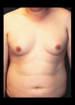 Before Image: Severe Gynecomastia before and after - front