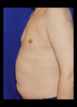 After Image: Severe Gynecomastia before and after - front
