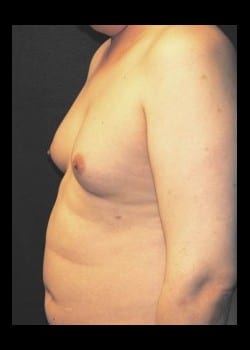 Before Image: Severe Gynecomastia before and after - front