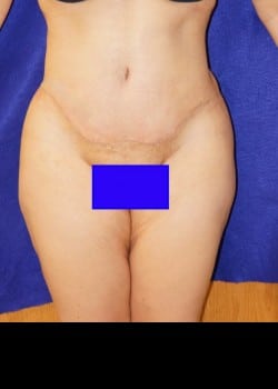 After Image: Abdominoplasty and abdomen and flank liposuction - front