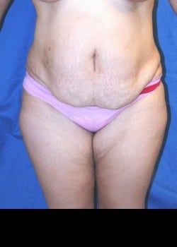 Before Image: Abdominoplasty and abdomen and flank liposuction - front