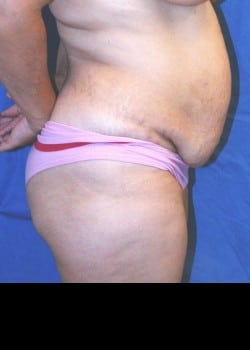 Before Image: Abdominoplasty and abdomen and flank liposuction - other