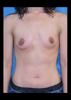 Before Image: Breast Enhancement with Silicone Implants - front