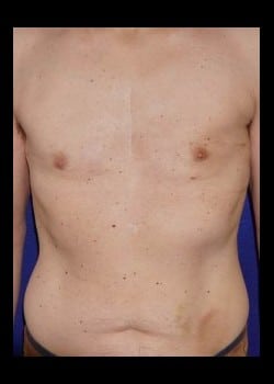 After Image: Male Breast Reduction - front