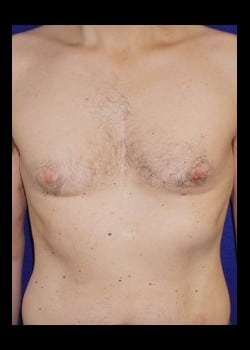 Before Image: Male Breast Reduction - front