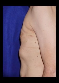 After Image: Male Breast Reduction - other