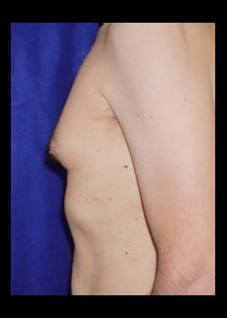 Before Image: Male Breast Reduction - other