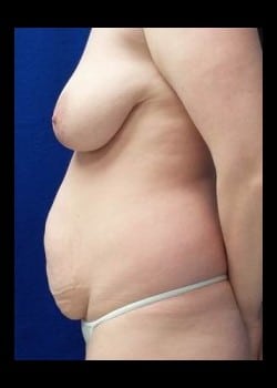 Before Image: Mommy Makeover with Tummy tuck, Liposuction , Breast augmentation and Breast Lift - other