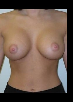 After Image: Breast Enhancement with saline breast implants - front
