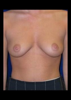 Before Image: Breast Enhancement with saline breast implants - front