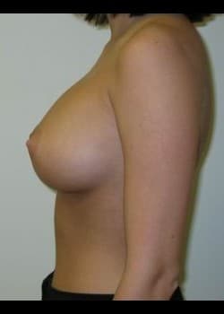 After Image: Breast Enhancement with saline breast implants - other