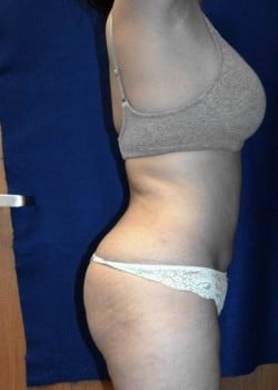 After Image: Liposuction and Gluteal Augmentation by Fat Grafting - other
